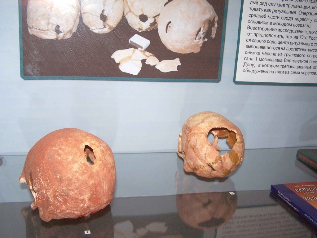 Древняя донская трепанация черепа.