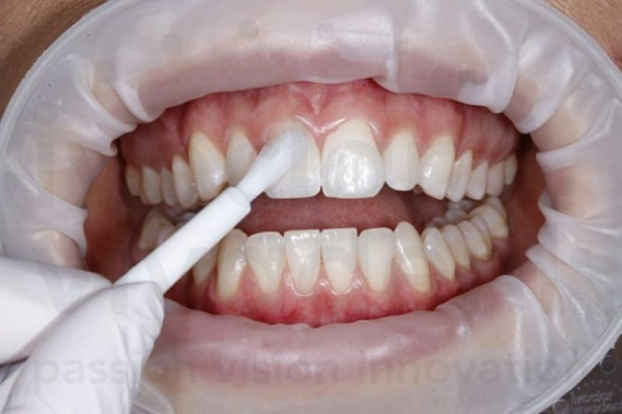 Зубная эмаль может восстанавливаться