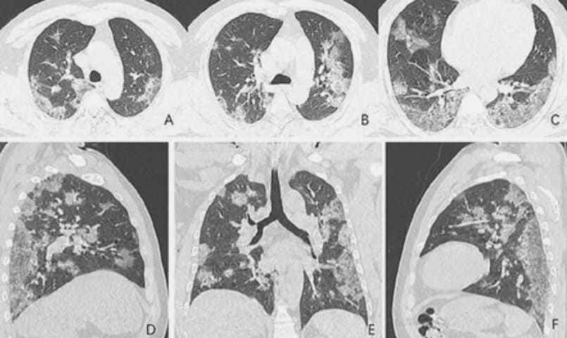 У умерших от ковида прежде всего повреждены легкие