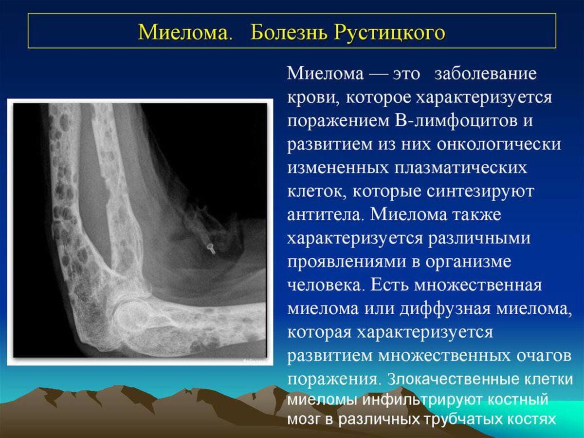 Ростовские врачи добились выраженной ремиссии пациента с миеломой III стадии