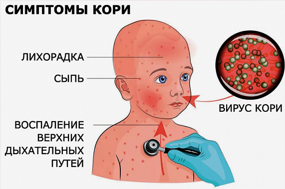 На Дону сохраняется тенденция к росту заболеваемости корью