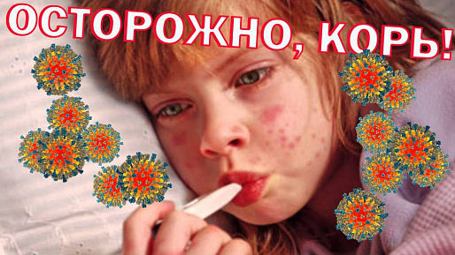 В Ростовской области сохраняется циклический подъем заболеваемости корью